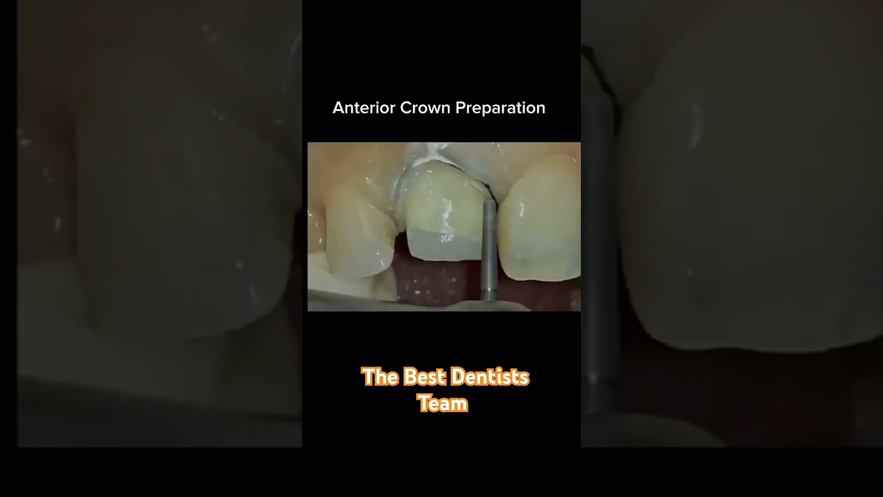 Anterior crown preparation for central incisor