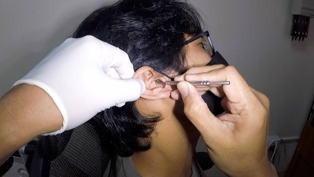 Removing One Huge Earwax Stuck in Man's Ear YouTube