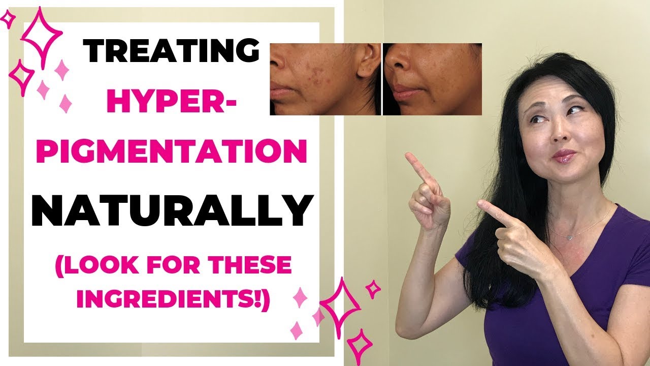 Treat Hyperpigmentation Naturally Youtube