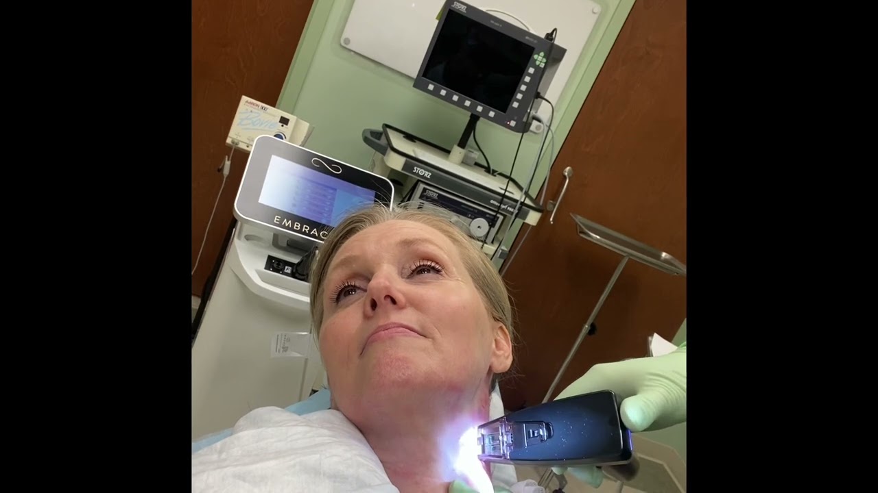 Morpheus 8 Oh what journey!! THIRD TREATMENT