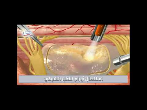 فيديو: ماذا يعني استئصال النخاع؟