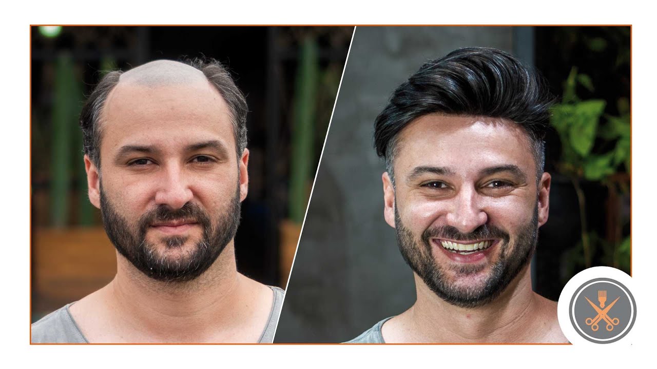 Silicone Masculino Antes E Depois Aplicação de Prótese Capilar Masculina - YouTube