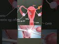Tubectomy vs Vasectomy | Permanent Contraception Explained | Family Planning Methods