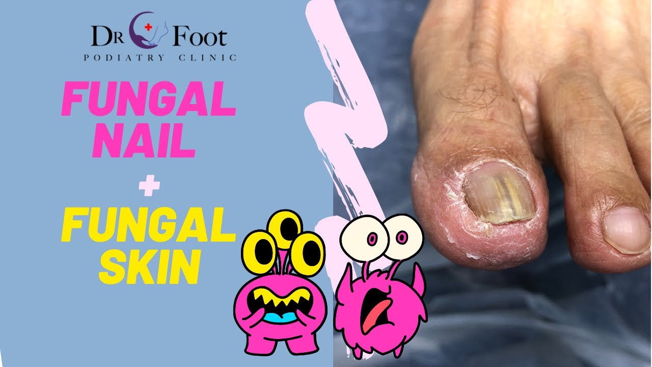 Nail Fungus Treatment | Canada MedLaser