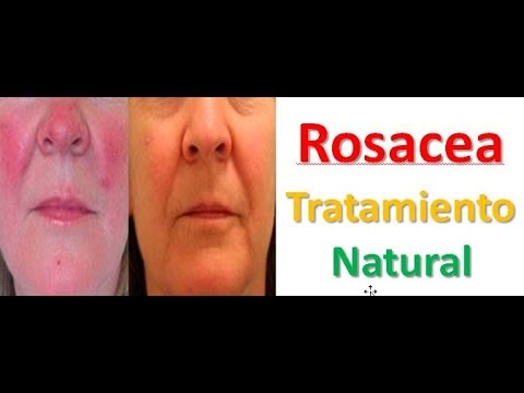 Rosacea Tratamiento Natural - Rosacea En El Cuerpo - Acne Rosacea