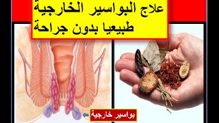 تعرف على شكل البواسير الداخلية بالصور الحقيقية طبيب ويب