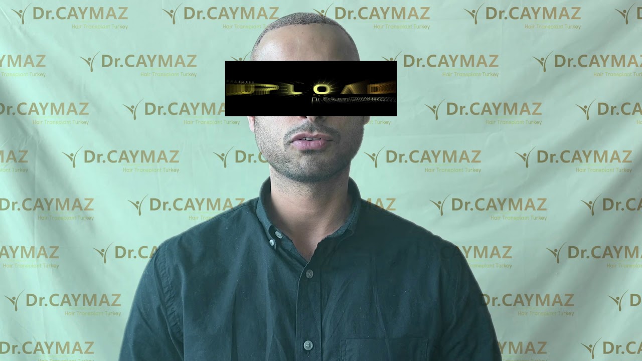 Mr.Private from Usa 4000 Graft Implanted | Hair Transplant in Istanbul Turkey | Dr.Caymaz