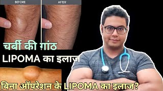 Doctor Explains: Lipoma ; Treatment without surgery and with surgery । LIPOMA का इलाज बिना ऑपरेशन के screenshot 3