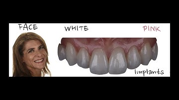 Implants, The Pink and White with Peter Pizzi, CDT, MDT