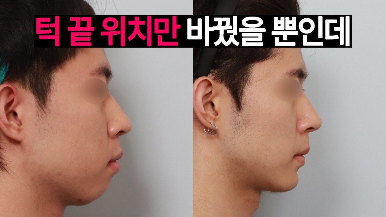 내 입이 튀어나온 건, 턱 끝 때문이다?🙄 윤곽수술, 턱끝 수술로 돌출입, 입꼬리 처짐, 턱끝 호두주름, 이중턱 해결 완료