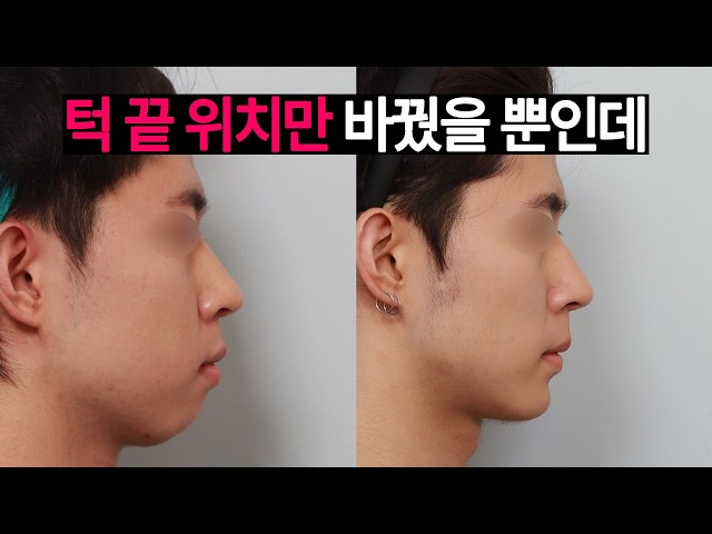 내 입이 튀어나온 건, 턱 끝 때문이다?🙄 윤곽수술, 턱끝 수술로 돌출입, 입꼬리 처짐, 턱끝 호두주름, 이중턱 해결 완료