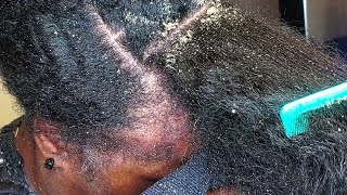 Dandruff Scratching With Hair Wash | Shampoo Service After Removing Flakes From Hair and Scalp