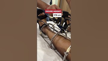 Limb lengthening surgery | Height increase surgery  #heightsurgery #heightincreasesurgery
