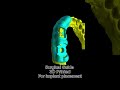 Digitally Planned Dental Implant Placement Workflow
