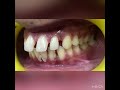Orthodontic Space Closure Gap Closure Orthodontic Treatment Trending mp3