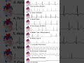 ECG #medicalstudent #norcet #education
