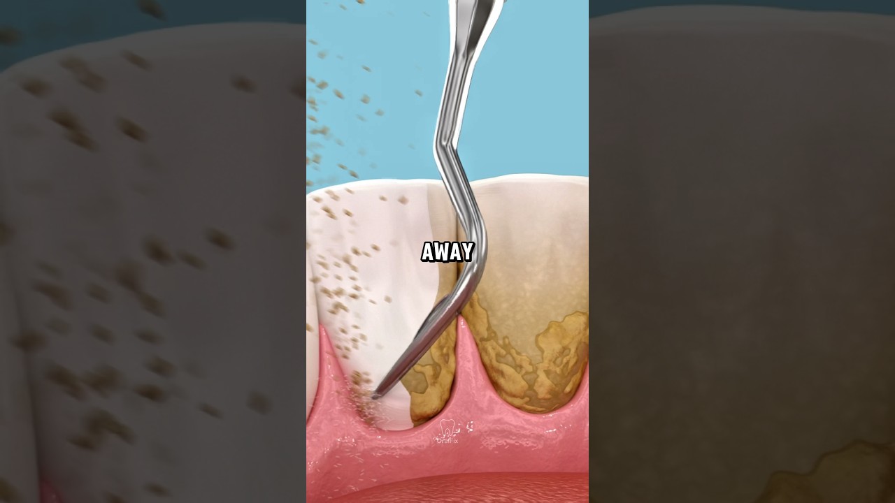 That Yellow Crust on Your Teeth? Here’s the Truth 🦷 