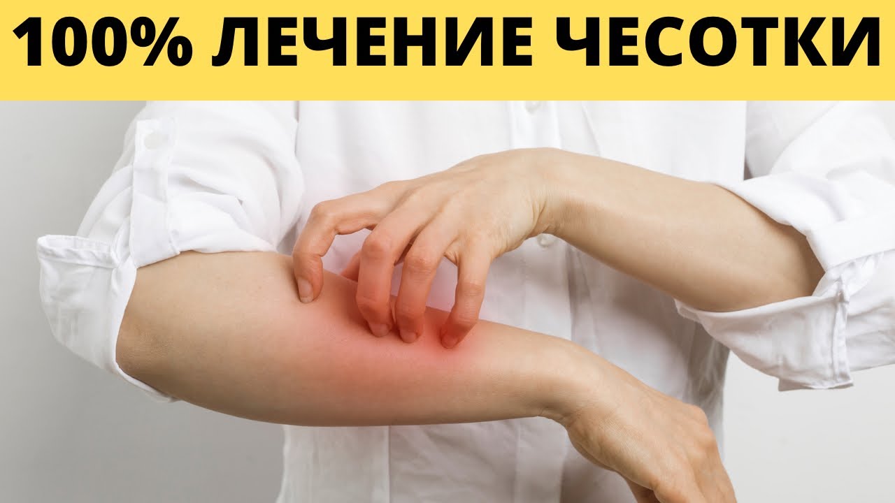 Избавьтесь от ЧЕСОТКИ в домашних условиях. Зуд на коже - YouTube