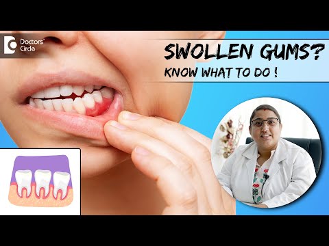 Video: 3 Ways to Treat Angular Cheilitis