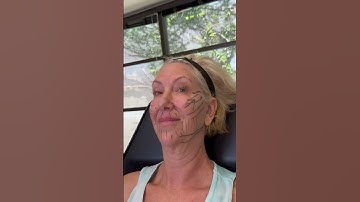 PDO Thread Lift: Your Non-Surgical Facelift Solution! 💫