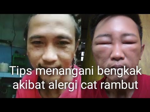 Video: Alergi Pewarna Rambut: Gejala, Rawatan, Dan Alternatif Warna