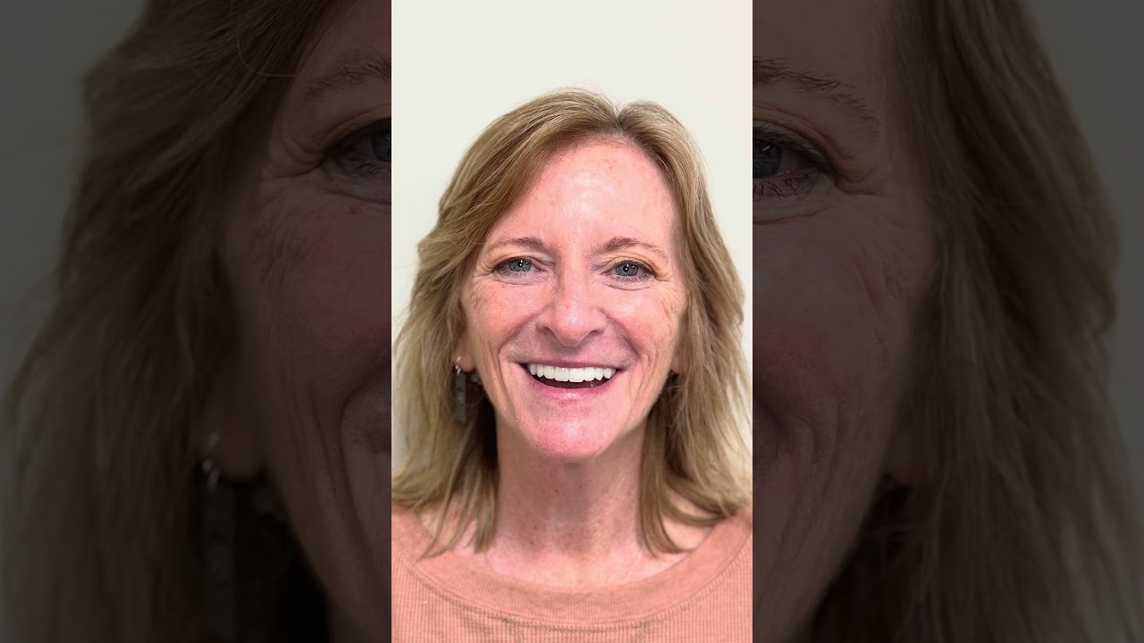 3 on 6 Smile Restoration Success Story