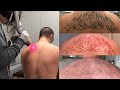 Laser Tattoo Removal - The Ugly Truth