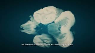 Unlocking the Truth About Brain Tumors: Expert Insights | Manipal Hospitals