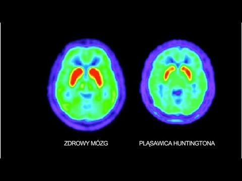 Wideo: Różnica Między Chorobą Parkinsona A Chorobą Huntingtona