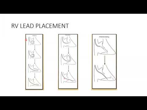 7- Implantation of Pacemaker: techniques & diagnosis of early complications - Dr. Emmanual Fares