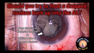 Should you try to rescue a dropped nucleus during cataract surgery?