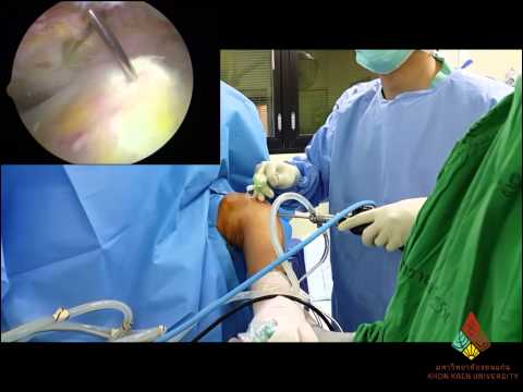 Arthroscopic treatment of Calcific Tendonitis "การผ่าตัดส่องกล้องรักษา ภาวะผลึกหินปูนในเอ็นข้อไหล่"