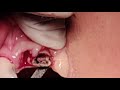 maxillary setup for extraction#completedenture