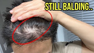 Im Balding Again...after Two Hair Transplants..
