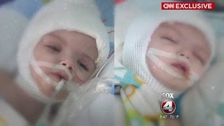 Conjoined Twin Boys Recovering