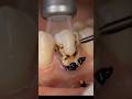 This Tiny Spot Can Destroy Your Tooth 😳#DentalFacts #ToothDecay #Cavity