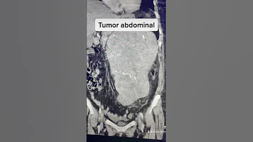 ¿Cómo se diagnostican los tumores abdominales?