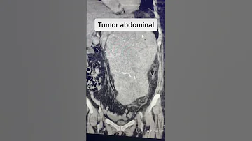 ¿Qué cánceres puede detectar un TAC abdominal?