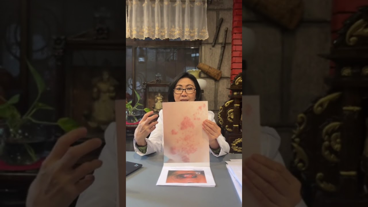 Narito ang ilan sa mga senyales sa balat kapag ang isang tao ay may HIV.