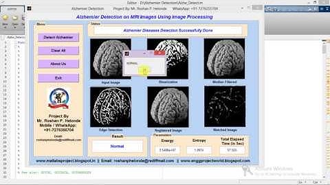 Matlab Code for Alzhemier Diseases Detection on MRI Images Using Image Processing