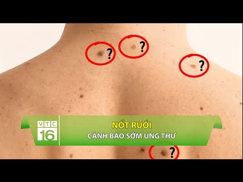 Nốt Ruồi Màu Nâu - Chẩn đoán sớm ung thư qua... nốt ruồi | VTC16