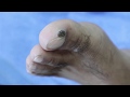 Ep_677 Callus removal  👣 น้องเขาเป็นอะไรที่นิ้ว? 😲 (This clip from Thailand)