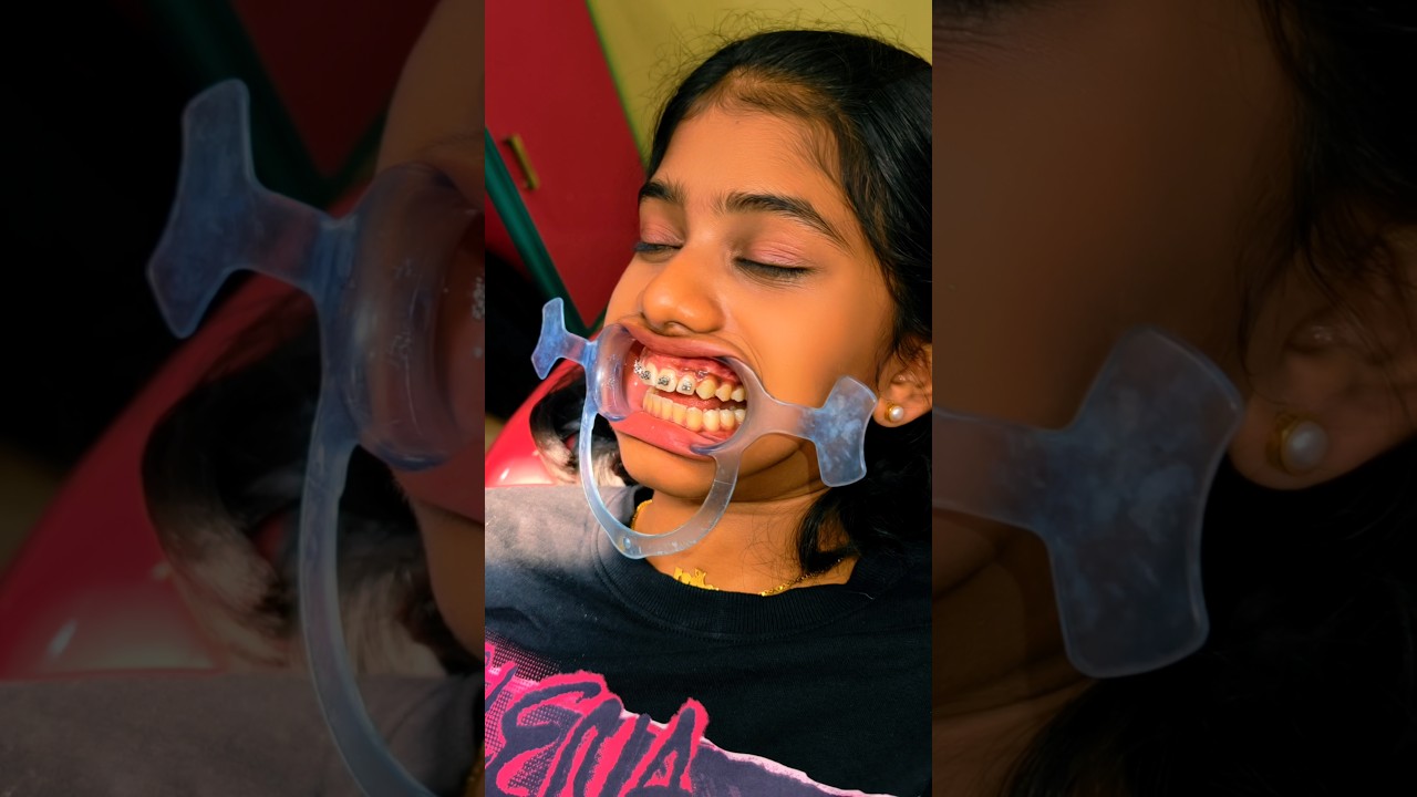 #Tiyakutty #പല്ലിലെ🦷 #Retainer അയച്ചു വീണ്ടും  #Braces ഇട്ടു😂😂😂