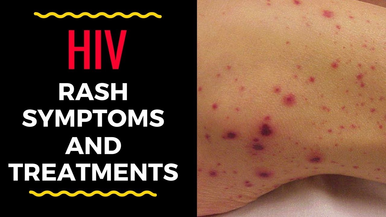 hiv lesions back