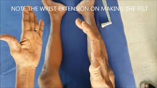 Hoffmann S Sign Physiopedia