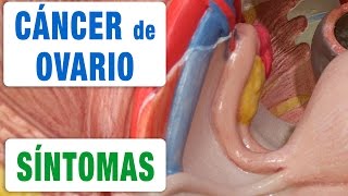 Todos los Síntomas del Cáncer de Ovario