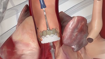 Valve SAPIEN 3 Ultra RESILIA