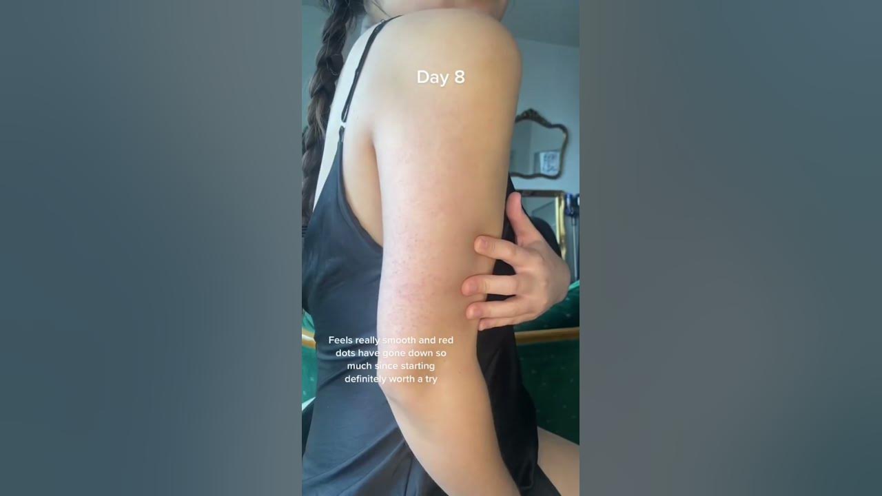 Kp update! // keratosis pilaris chicken skin strawberry skin body care skincare tips journey hacks Kp update! // keratosis pilaris chicken skin strawberry skin body care skincare tips journey hacks