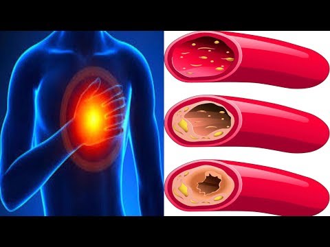 9 Ways You Can Clear Your Clogged Arteries Naturally!