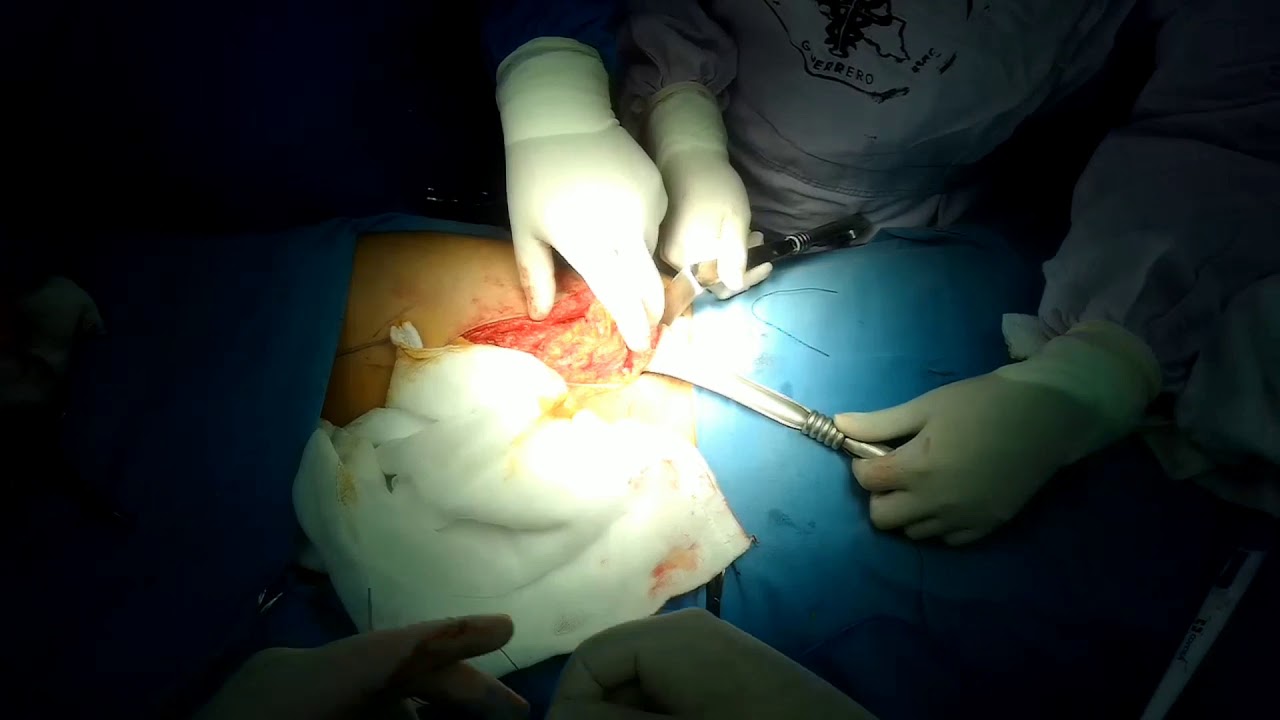 Disección inguinal